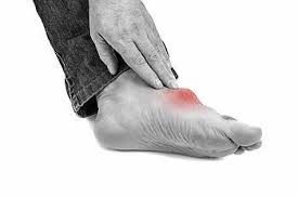 Image result for gout
