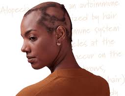 Image result for Alopecia