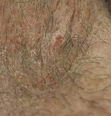 While these commonly happen in people who have curly hair, almost anyone can have. Ingrown Hair Ingrown Hair On My Scrotum