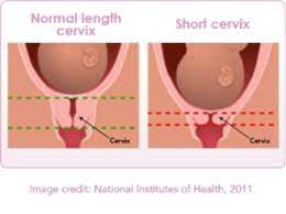 Open vs closed cervix pictures early pregnancy. Cervical Insufficiency And Short Cervix