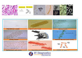 Image result for Urinary Cast