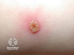 Image result for Varicella zoster on human skin