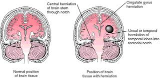 Herniation Definition Of Herniation By Medical Dictionary But if you take the right.