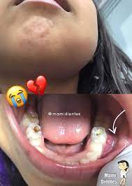 Mami Dientes Esta Semana Me Llego A Consulta Una Nina De 6 Anos De Edad Con Asimetria Facial Cara Hinchada De Un Lado Como Ven En La Imagen Limitada