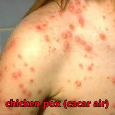 Chickenpox is a highly contagious infection. Redakan Chicken Pox Dengan Shaklee Teman Vitamin Anda