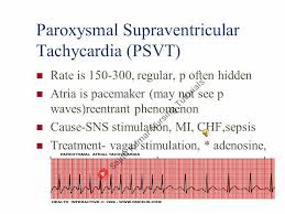 It may be terminated with a vagal maneuver. Paroxysmal Sajith Kumar Nursing Tutorials Facebook