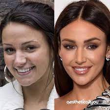 Aesthetically you · cqc accredited medical skin & aesthetic centre specialising in skin, face & body treatments liverpool 01517090011 book online 213 Mentions J Aime 3 Commentaires Aesthetically You Aestheticallyyou Sur Instagram Oh Michelle Michelle Michelle Lip Augmentation Lip Fillers