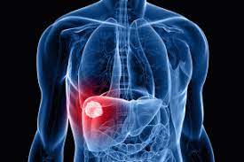 Read our blog to learn about liver cancer symptoms, signs, types, causes, stages, diagnosis, treatments, risk factors hepatocellular carcinoma usually affects people suffering from liver damage as a result of alcohol abuse. First Functional Liver Tumour Organoids Developed Ecancer