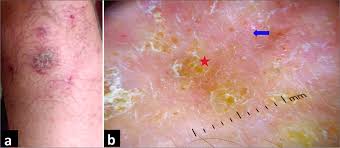 Image result for Dermoscopy