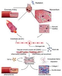 Radiation Induced Heart Disease Rihd List Of Frontiers Open Access Articles