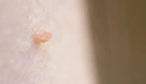 سيدتي الولايات المتحدة الأمريكية يمارس اشكال الزوائد الجلدية بالصور talkaboutcheesecake com