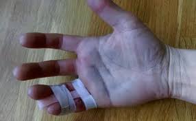 Image result for Hand Fracture