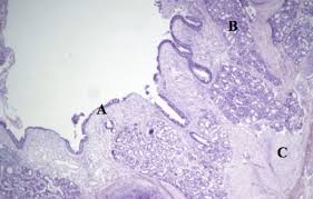 Image result for Chronic Bronchitis