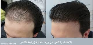 الإهتمام بالشعر قبل و بعد عملية زراعة الشعر Best Hair Transplant Hair Transplant Cost Body Hair Transplant
