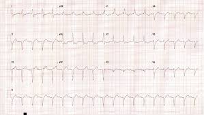 It was undetermined if these patients had myocarditis. Acute Myocarditis With Cardiogenic Shock In A Healthy Young Man Cardiology