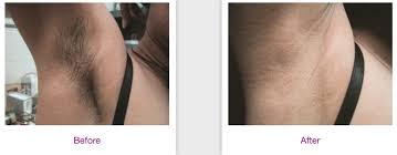 Laser skin center get directions hours: Laser Hair Removal Boston Dermphysicians Of New England