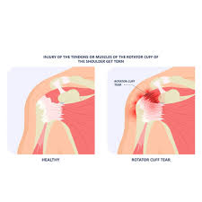 Image result for Rotator Cuff Injury