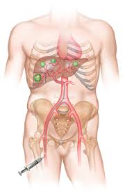Vascular | ChemoEmbolization (TACE) for Liver Cancer