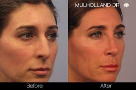 How do they fix a deviated septum. Can Rhinoplasty Correct A Deviated Septum Tps