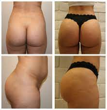 Boxes are available in rental periods of six or 12 months. Best Brazilian Butt Lift Los Angeles Bbl Beverly Hills