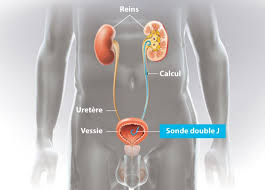 J'ai eu ça il y 2 ans et benh a quelques heures pres, je perdais un rein. Sonde Urinaire En Double J Ramsay Sante