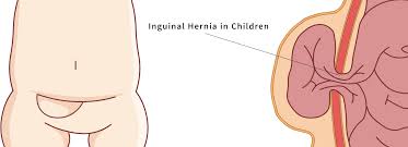 Image result for Inguinal hernia child