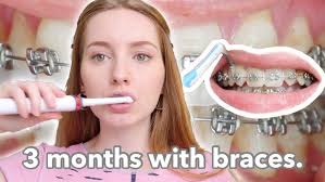 Can I Still Eat My Favorite Foods in Braces?", with Dr. Taylor Varner,  Orthodontist