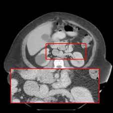 Retroaortic Left Renal Vein Radiology Reference Article Radiopaedia Org