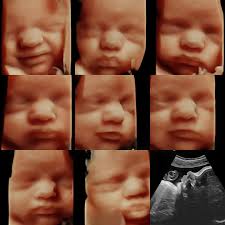 This Little Piggy 3D/4D and HD Live Ultrasound