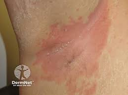 Image result for Generalized Rash