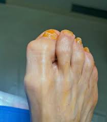 Great Toe arthritic hammertoe ( Curvature ) corrected #sanmateofootsurgeon  #sanmateopodiatrist #bayarefootsurgeon #bayareapodiatrist