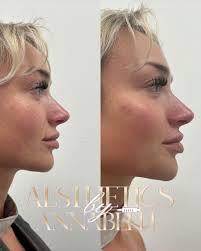 Lips jaw and chin package 🧚‍♀️ Absolutely stunning results We still have a  couple of slots for tomorrow evening at Angel Face Cosmetics for our  content day. Must be ok with being