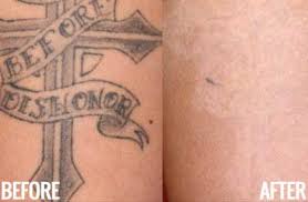 Here's what you should know before booking a tattoo removal i have four (five, if you count the one on my back as two) tattoos from my late teens and early twenties that i could probably definitely do without. Laser Tattoo Removal Southeastern Dermatology In Knoxville Tn