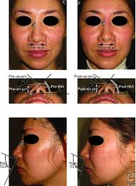 Photographs of the flat lower one-third nose type in a 37-year-old...
