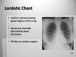 What does nodulohazy densities mean? Pathology 91 Spring 2010 Draft Ppt Video Online Download