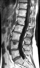Image result for Low Back Imaging