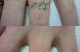 Laser tattoo removal services in portland oregon has come a long way in the last ten years. Non Laser Vs Laser Tattoo Removal