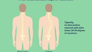 Последние твиты от rib cage (@officialribcage). Scoliosis Overview And More