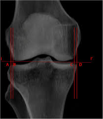 One presumed mechanism of injury is a stieda fracture (avulsion injury of the medial collateral ligament at the medial femoral condyle). The Distal Femur Is A Reliable Guide For Tibial Plateau Fracture Reduction A Study Of Measurements On 3d Ct Scans In 84 Healthy Knees Journal Of Orthopaedic Surgery And Research Full Text