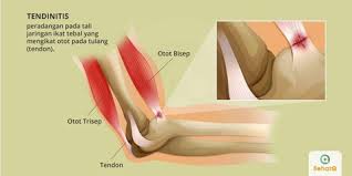 Tendinitis Tanda Dan Gejala Penyebab Cara Mengobati Cara Mencegah