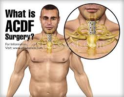 Pin By Jami On Work Project Acdf Surgery Surgery Neck Surgery