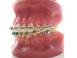 Class Ii Right Class Iii Left Elastics About Braces