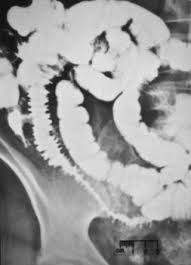 Image result for Radiation Colitis