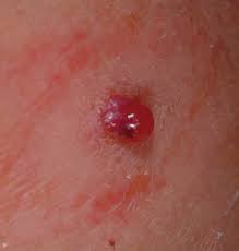 Though if the marks tend to bleed easily if traumatized, you should see your doc to rule out anything and if the bumps are in places you'd rather they not be (like on your face), they can be treated for cosmetic. 10 Year Old With Bright Red Papule