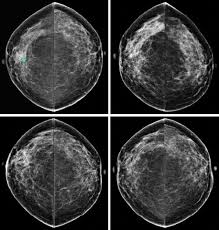 Breast mri images are combined, using a computer, to create detailed pictures. Study Finds Women With High Breast Cancer Risk Declining Mri Screening Imaging Technology News