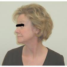 PDF) Pectoralis Minor Syndrome: Subclavicular Brachial Plexus Compression