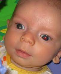 Here are common signs to be aware of. World Eye Cancer Hope Life And Sight For Every Child