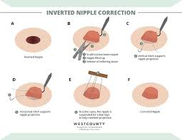 Image result for Nipple Inversion