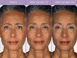 Botox is completely safe to use and has been. Botox Before And After Photos Woodlands Dermatology Spring Katy