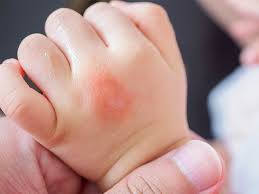 Image result for Papular urticaria